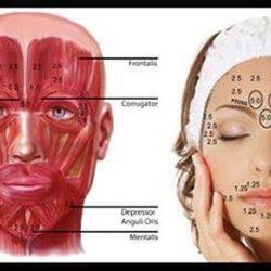 Wilton Aesthetic Center - Where is Botox injected and how much?