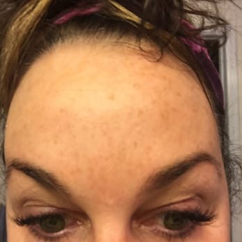 Jen Lewis - Before (sun spots) - Skin Care Near Me - Centennial, Colorado Jen Lewis - Before (sun spots) - Skin Care Near Me - Centennial, Colorado