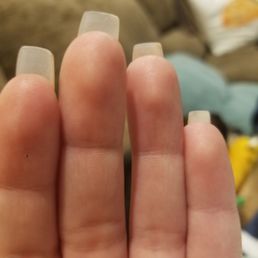 Middle nail finger severely crooked. Middle nail finger severely crooked.