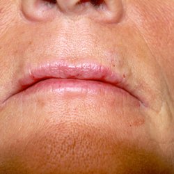 Miss Botox Fort Worth - After subtle lip plumping and fine line smoothing with 1 syringe of Juvederm Volbella.