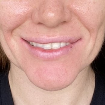 VIOR Life & Aesthetics - Several days after the first injection I was looking very lumpy and lopsided. - Medical Spas Near Me - Miami, Florida VIOR Life & Aesthetics - Several days after the first injection I was looking very lumpy and lopsided. - Medical Spas Near Me - Miami, Florida