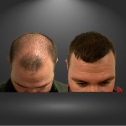 New England Center for Hair Restoration