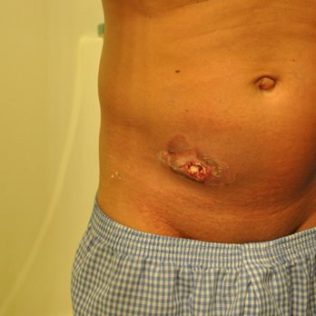 Australian Tan - This is that infection that i mentioned in my negative review against this dirty, and unprofessional place, that nearly caused my death. - Spray Tanning Near Me - Sunnyvale, California Australian Tan - This is that infection that i mentioned in my negative review against this dirty, and unprofessional place, that nearly caused my death. - Spray Tanning Near Me - Sunnyvale, California