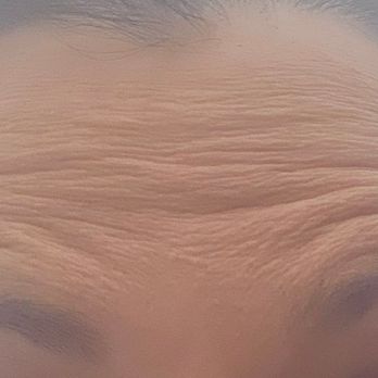 4Ever Young - 4 weeks in total after 36 units. Started with 32 went back they gave me 4. Usually 20 units of botox however they did 36. Suchna rip off!!! - Medical Spas Near Me - Edgewater, New Jersey 4Ever Young - 4 weeks in total after 36 units. Started with 32 went back they gave me 4. Usually 20 units of botox however they did 36. Suchna rip off!!! - Medical Spas Near Me - Edgewater, New Jersey