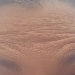 4 weeks in total after 36 units. Started with 32 went back they gave me 4. Usually 20 units of botox however they did 36. Suchna rip off!!!
