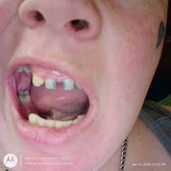 Elite Dentistry - Broken teeth left - General Dentistry Near Me - Vancouver, Washington
