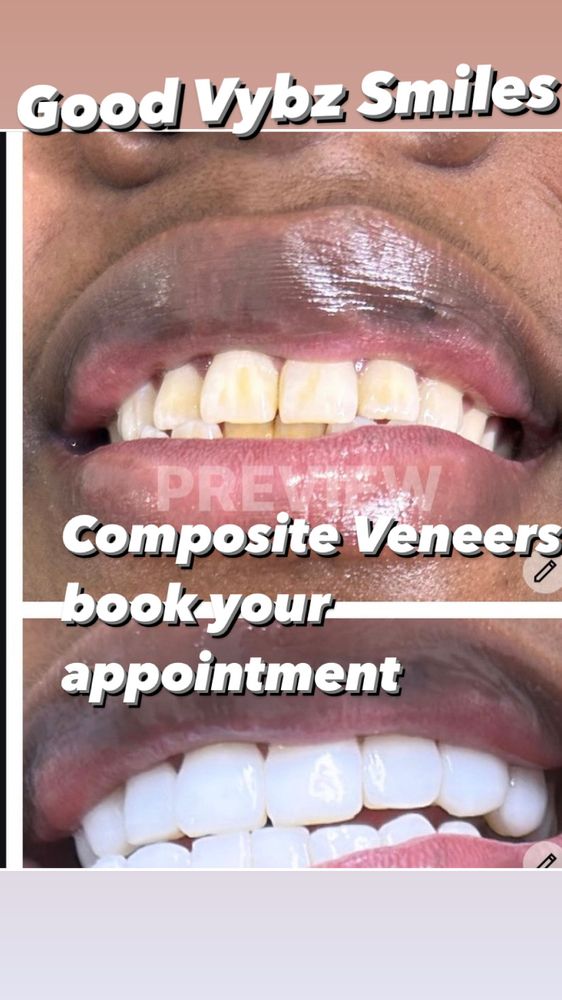 GOOD VYBZ COMPOSITE VENEERS Updated August 2024 12 Photos Atlanta