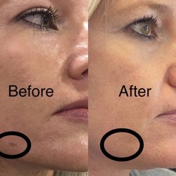 Martinni Beauty - Before and after pigment removal