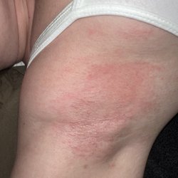 The Point Effect - Underarm post treatment