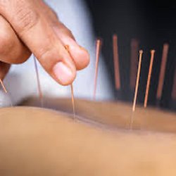 Breathing Hands Wellness and Acupuncture PLC - Acupuncture treatment