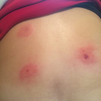 Super 8 by Wyndham Quartzsite AZ - Bed bug bites on my wife! - Hotels Near Me - Quartzsite, Arizona Super 8 by Wyndham Quartzsite AZ - Bed bug bites on my wife! - Hotels Near Me - Quartzsite, Arizona