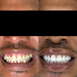 Encino Dental Smile - Full mouth case traveling patient from Orlando