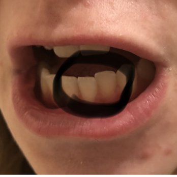 Charleston Orthodontics - Mt Pleasant - That tooth was straight until she was given a retainer that didn't fit properly and she WORE THEM every night until they no longer fit. - Orthodontists Near Me - Mount Pleasant, South Carolina Charleston Orthodontics - Mt Pleasant - That tooth was straight until she was given a retainer that didn't fit properly and she WORE THEM every night until they no longer fit. - Orthodontists Near Me - Mount Pleasant, South Carolina