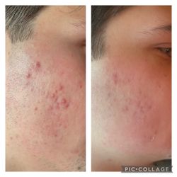 Sonia's Waxing & Skincare - This is after just ONE treatment!