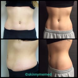 Photo of Skinny Me Med - Van Nuys, CA, US. One of our patients post 12 weeks after SculpSure