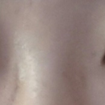 Aesthetic KS - 3 days post-op - Cosmetic Surgeons Near Me - Los Angeles, California Aesthetic KS - 3 days post-op - Cosmetic Surgeons Near Me - Los Angeles, California