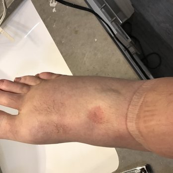 Anti Aging Weight Loss Clinic - Feet very swollen after treatment. Why?! - Medical Spas Near Me - Mountain View, California