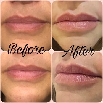 Nirvana Med Spa - Lip Fillers - Laser Hair Removal Near Me - Little Rock, Arkansas Nirvana Med Spa - Lip Fillers - Laser Hair Removal Near Me - Little Rock, Arkansas