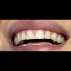 Millennium Family Dental - My teeth before dental bonding (no gap)