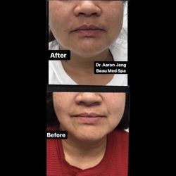 Nasolabial fillers using a cannula