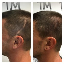 Tailored Micro Ink - Follicle replication treatment aka Scalp Micropigmentation is the safest, most natural-looking way to camouflage scars on your scalp.