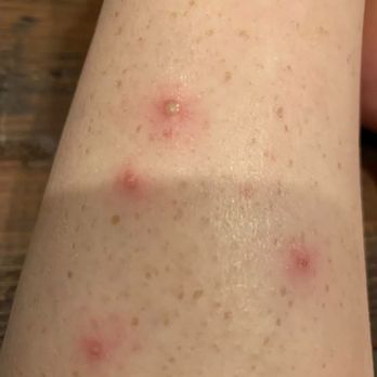 River Nails and Spa - Folliculitis - Nail Salons Near Me - Eugene, Oregon