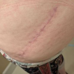 Premier Orthopaedic And Trauma Specialists - Same Hip Replacement Scarring Beautifully.