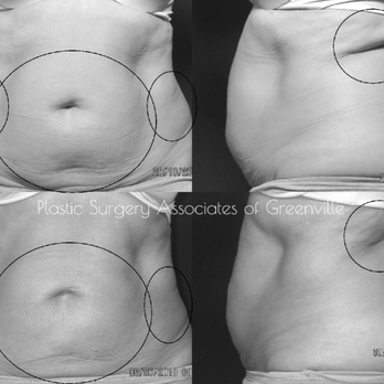 Plastic Surgery Associates - Coolsculpting - Medical Spas Near Me - Greenville, South Carolina Plastic Surgery Associates - Coolsculpting - Medical Spas Near Me - Greenville, South Carolina