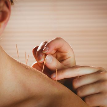 Revive Acupuncture - Dry needling in Fremont performed by licensed acupuncturists at Revive Acupuncture. - Acupuncture Near Me - Fremont, California