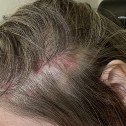 Lena Hair Salon - Blister scalp burn