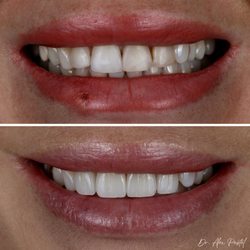 Pastel Dental - Porcelain Veneers can create a more youthful smile!