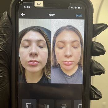 NakedMD - My chin filler before and after! - Medical Spas Near Me - Downey, California NakedMD - My chin filler before and after! - Medical Spas Near Me - Downey, California