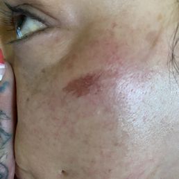 Burn from washing peach fuzz Burn from washing peach fuzz