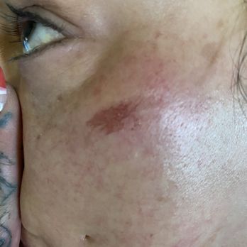 A Signature Day Spa - Burn from washing peach fuzz - Day Spas Near Me - Rutland, Vermont A Signature Day Spa - Burn from washing peach fuzz - Day Spas Near Me - Rutland, Vermont