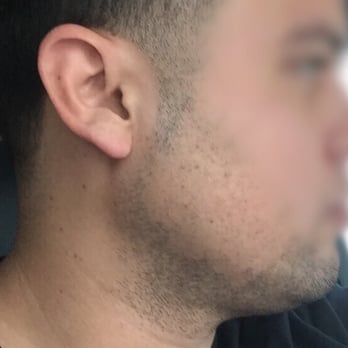 Leonel Calderón, MD - After traumatizing experience. No beard grows in patches - Medical Spas Near Me - Miami, Florida