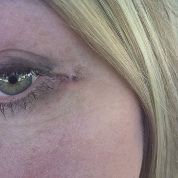 Bright Eyes MD - Pinching from permanent sutures - Cosmetic Surgeons Near Me - San Diego, California