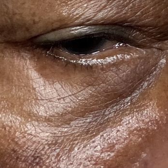 Austin Face & Body - Hallow undereyes, was supposed to get a fat transfer - Medical Spas Near Me - Austin, Texas Austin Face & Body - Hallow undereyes, was supposed to get a fat transfer - Medical Spas Near Me - Austin, Texas