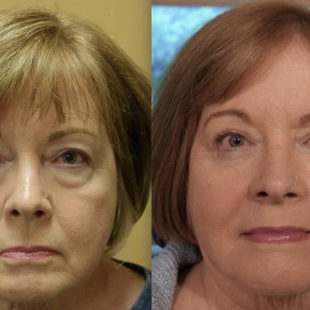 In Focus Ophthalmic Plastic Surgery - Before and After Eyelid Surgery - Plastic Surgeons Near Me - Murrieta, California In Focus Ophthalmic Plastic Surgery - Before and After Eyelid Surgery - Plastic Surgeons Near Me - Murrieta, California