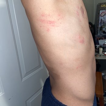 Integrity Oklahoma - Bed bug bites. - Real Estate Services Near Me - Oklahoma City, Oklahoma Integrity Oklahoma - Bed bug bites. - Real Estate Services Near Me - Oklahoma City, Oklahoma