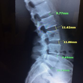SF Bay Wellness & Canyon Chiropractic - X-ray taken again after 3 months of treatment (adjustments twice a week). Spacing between discs is much better! - Chiropractors Near Me - San Ramon, California