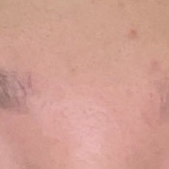 Newhope Laser Skin Care: Phuong Tien, MD - Before - Tattoo Removal Near Me - Westminster, California Newhope Laser Skin Care: Phuong Tien, MD - Before - Tattoo Removal Near Me - Westminster, California