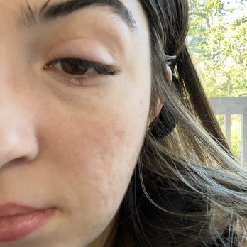 The Lash Lounge - Visibly inflamed and swollen after service - Threading Services Near Me - Walnut Creek, California The Lash Lounge - Visibly inflamed and swollen after service - Threading Services Near Me - Walnut Creek, California