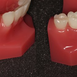 Dental World - Mini implant bridge for patients missing multiple teeth and minimal bone