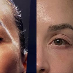 Northside Plastic Surgery - Temple filler before and after.