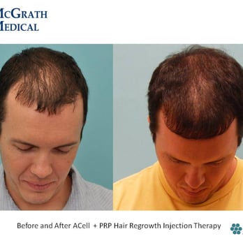 McGrath Medical - ACell Hair Regrowth Injection Therapy - Hair Loss Centers Near Me - Austin, Texas McGrath Medical - ACell Hair Regrowth Injection Therapy - Hair Loss Centers Near Me - Austin, Texas