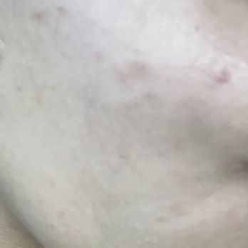 Face to Face Spa at Towne Lake - My face right after I left the same day - Medical Spas Near Me - Cypress, Texas Face to Face Spa at Towne Lake - My face right after I left the same day - Medical Spas Near Me - Cypress, Texas