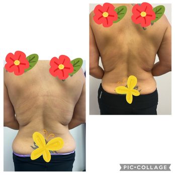 1 Stop Beauty Bar - Montebello - The bottom is the before picture. You can see my waist look inflamated & bloated. Top right picture is the after. Look at my waist now! - Makeup Artists Near Me - Montebello, California 1 Stop Beauty Bar - Montebello - The bottom is the before picture. You can see my waist look inflamated & bloated. Top right picture is the after. Look at my waist now! - Makeup Artists Near Me - Montebello, California