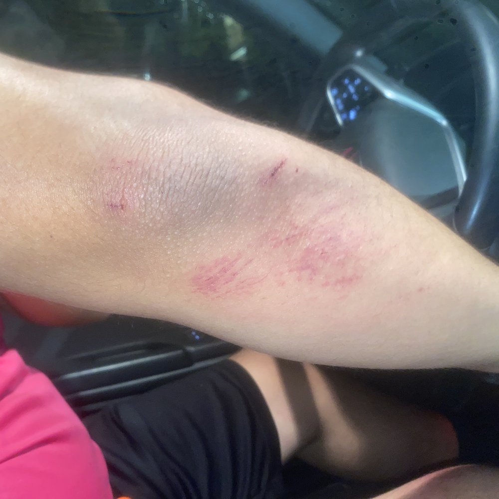 FXA Sports - My teammates arm after the altercation - Sports Clubs Near Me - Chantilly, Virginia FXA Sports - My teammates arm after the altercation - Sports Clubs Near Me - Chantilly, Virginia