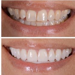 Watch for zoom whitening specials on our Facebook horseshoe bay dental.net
