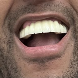 Glendale Top Dentist NY - To big is not oh my side oh my original teeth and the back teeth